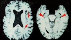 Brain disease in dead NFL players 'higher than previously shown' | UserInterface News